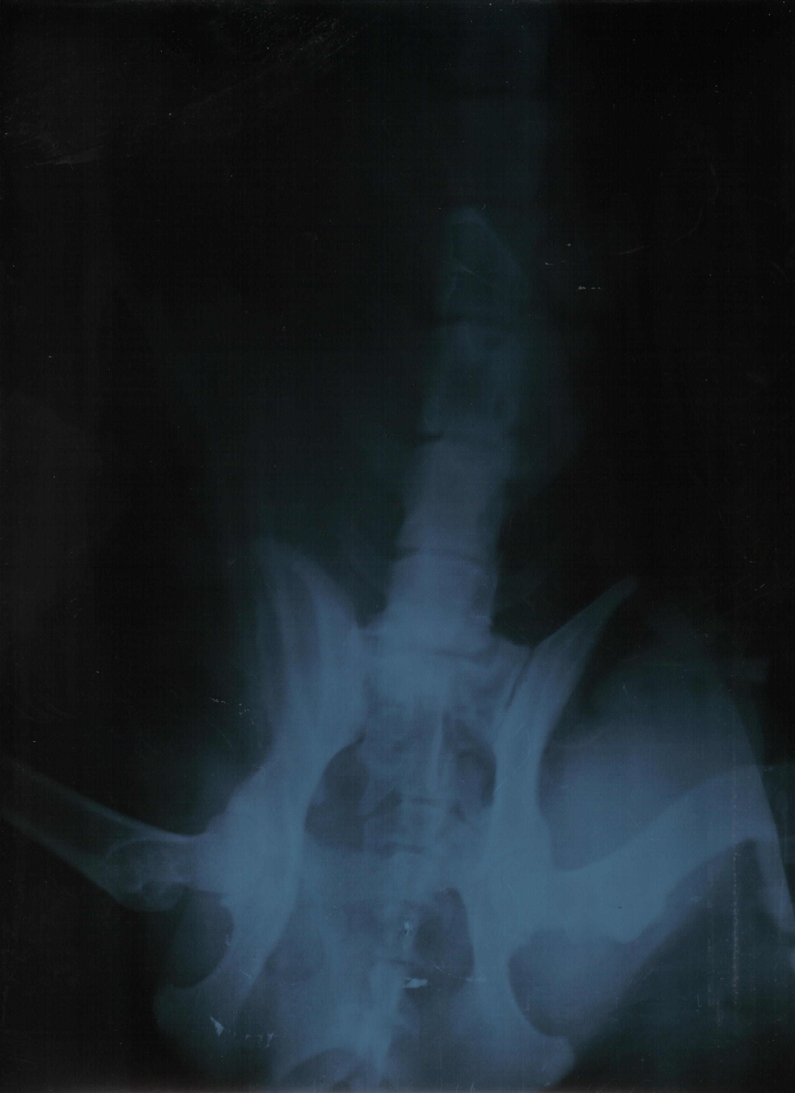 Adjunto osteoporosis.jpg